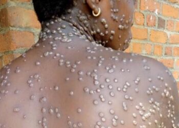 Namibia declares mpox outbreak after first confirmed case