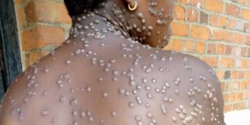 Namibia declares mpox outbreak after first confirmed case