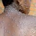 Namibia declares mpox outbreak after first confirmed case