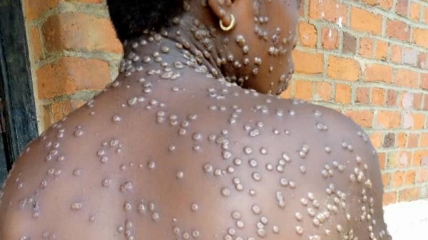 Namibia declares mpox outbreak after first confirmed case